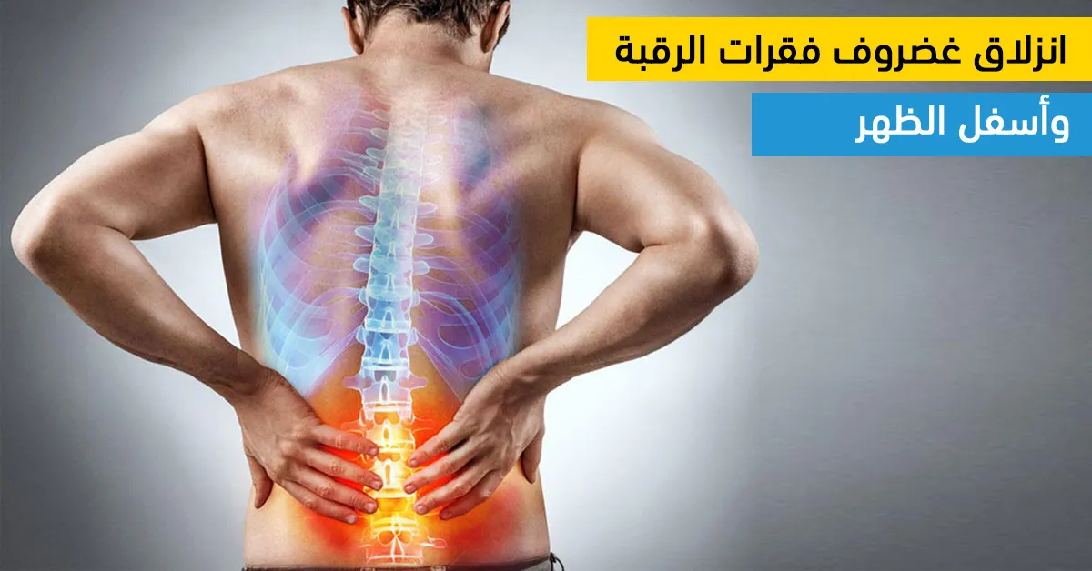 انزلاق غضروف فقرات الرقبة وأسفل الظهر